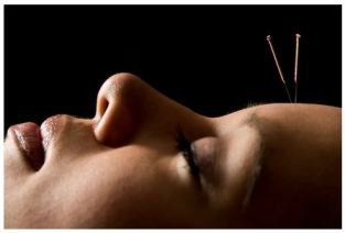 Is acupuncture the new botox.